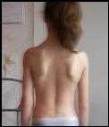 Scoliosis  After Bowen Scoliosis  After Bowen