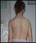 Scoliosis Before Bowen Scoliosis Before Bowen